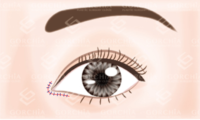 隱痕開眼頭手術-撥離眼頭區域的皮膚